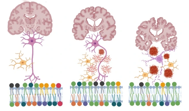 Scopus publica artículo sobre biomarcadores en Alzheimer